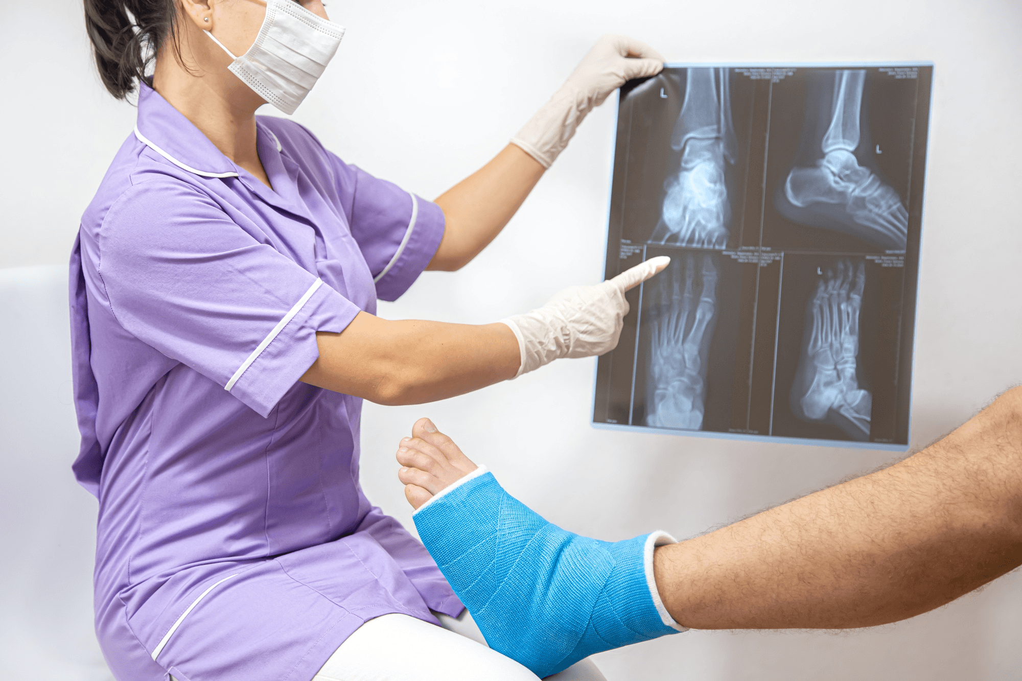 Fracture Recovery Timeline: How Long Does a Broken Bone Heal?